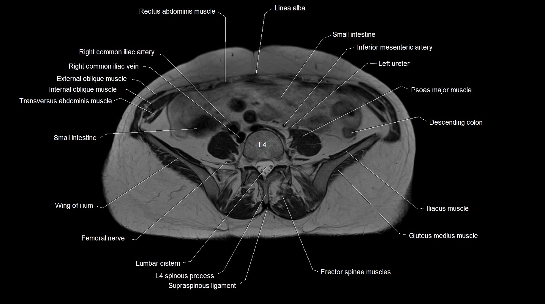 MRI 3T pelvis axial cross section anatomy image 2.webp
